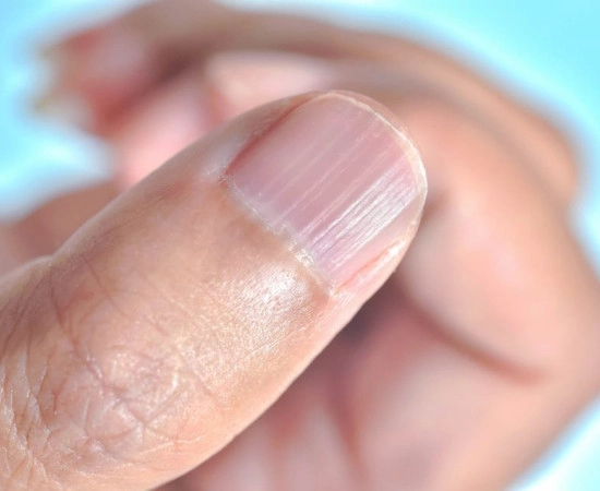 Чому нігті стають ребристими: важливий знак